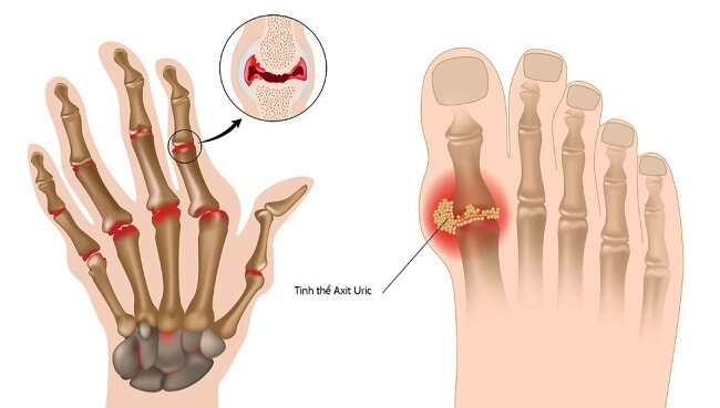 Người bệnh gout có thể ăn được cà pháo 