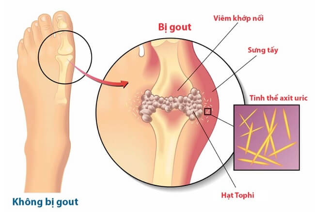 Người bệnh gout không nên ăn ngao