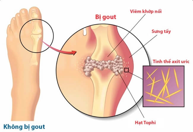 Ăn nhiều tôm khiến tăng triệu chứng bệnh gout