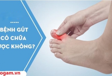  Giải đáp thắc mắc “Bệnh gout có chữa được không?”