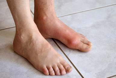 Rối loạn chuyển hóa purin – Nguyên nhân chính dẫn đến Bệnh Gout