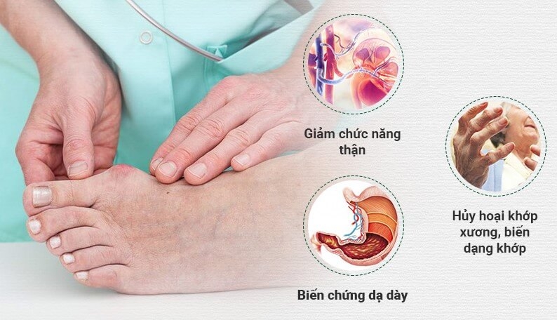 Sai lầm trong điều trị bệnh gout dẫn đến các biến chứng nguy hiểm