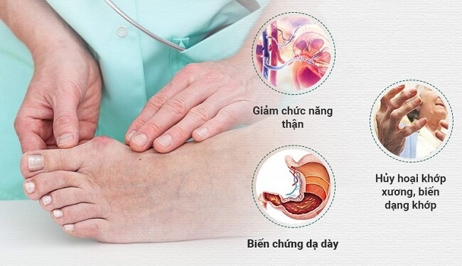 Biến chứng nguy hiểm của bệnh gout