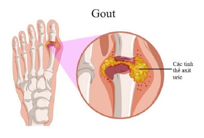 Sự lắng đọng của các tinh thể acid uric trong mô khớp gây ra cơn đau gout cấp