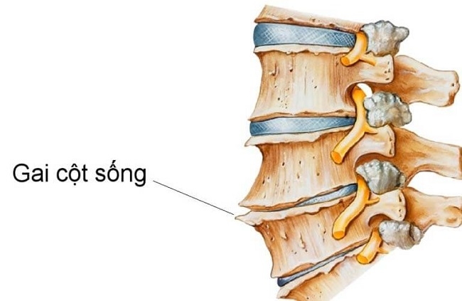 Gai cột sống là một trong số nhiều nguyên nhân gay ra đau lưng