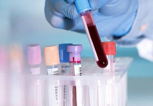 Xét nghiệm công thức máu và chỉ số sinh hóa máu là phương pháp xét nghiệm cơ bản