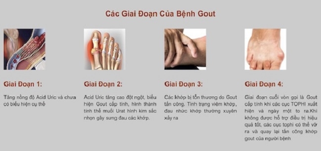 Các giai đoạn của bệnh gout