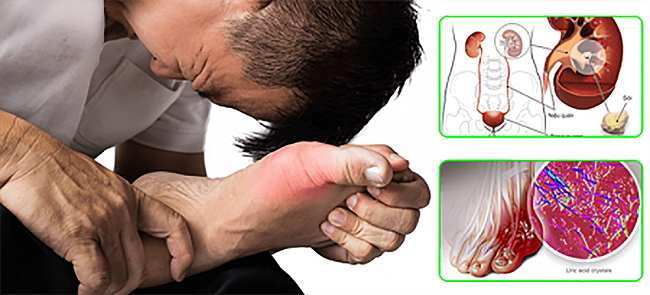 Bệnh gout gây sỏi thận chiểm tỷ lệ 10-20% trên  bệnh nhân bị gout