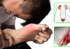 Bạn cần biết lý do tại sao bệnh gout gây sỏi thận?
